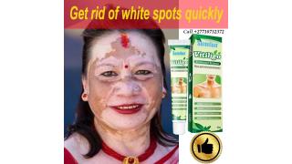 +2771 073 2372 Get Rid Of Vitiligo In Tidioute Borough in Pennsylvania